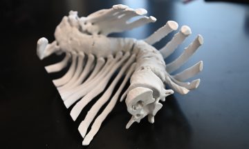 3D printed model of the spine of a patient with severe scoliosis.